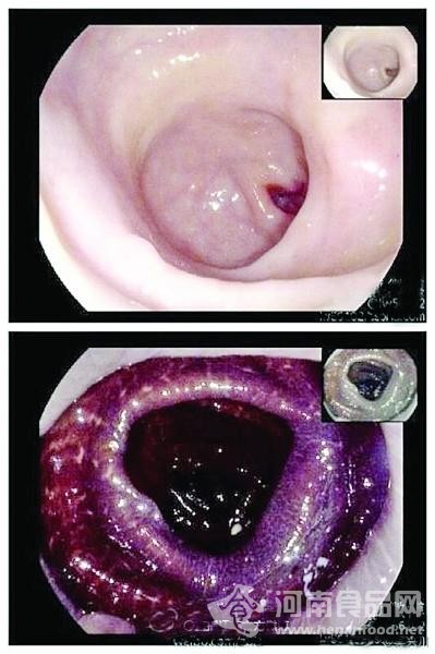 腸子變黑